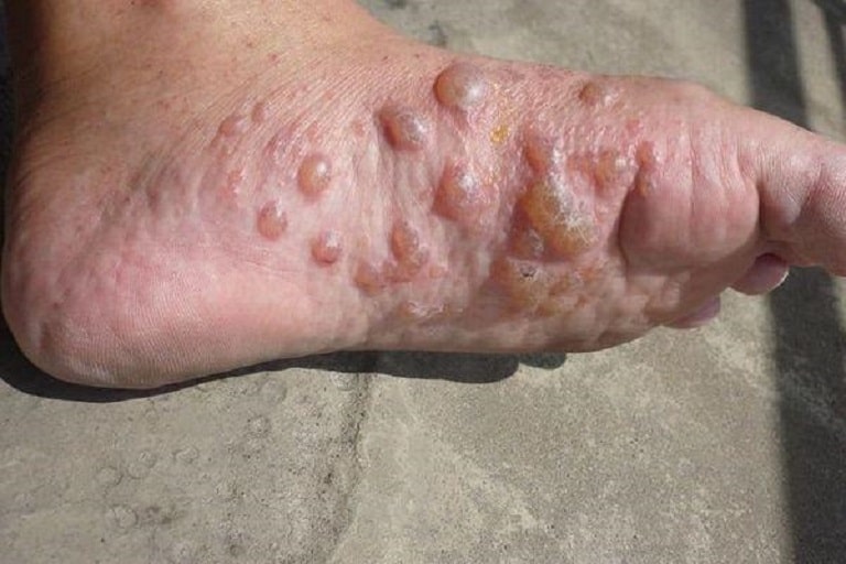 Hình ảnh bệnh tổ đỉa ở chân