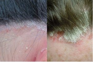 Bệnh vẩy nến da đầu là gì?  Dấu hiệu và Điều trị