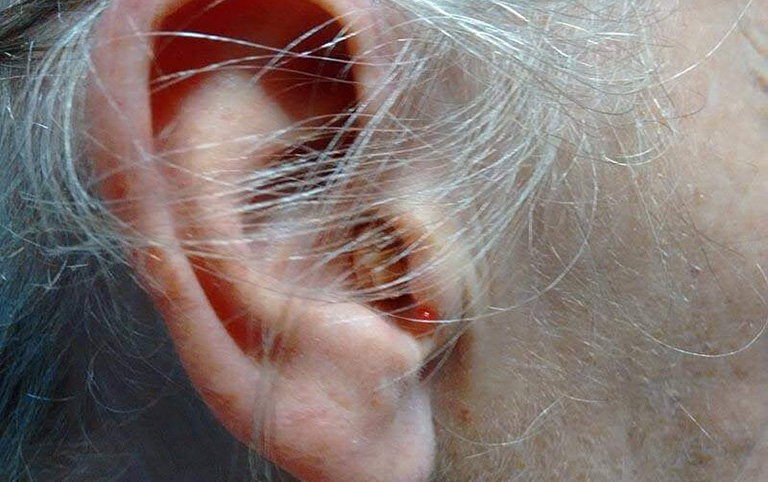 viêm tai ngoài là gì