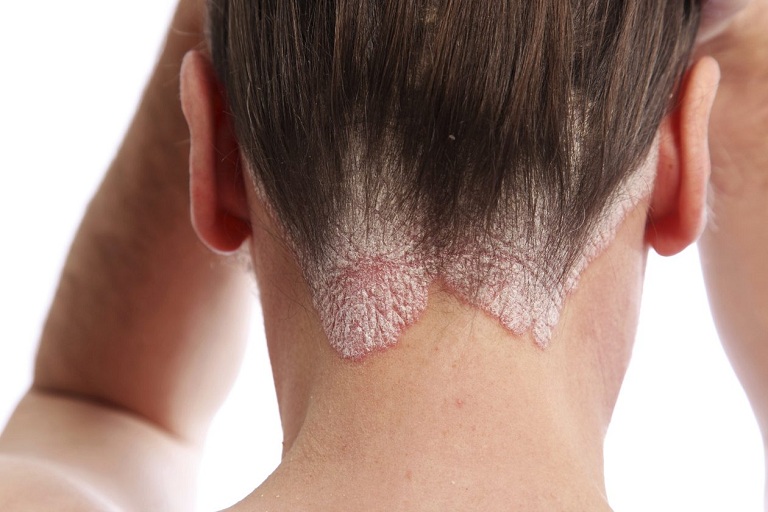 Bệnh á sừng ở da đầu – Nguyên nhân và cách điều trị đúng