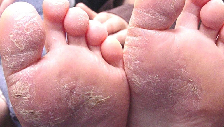 Bệnh á sừng ở chân – Cách nhận biết triệu chứng và điều trị hiệu quả nhất