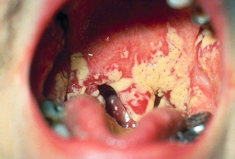 miệng bị nhiễm nấm candida 