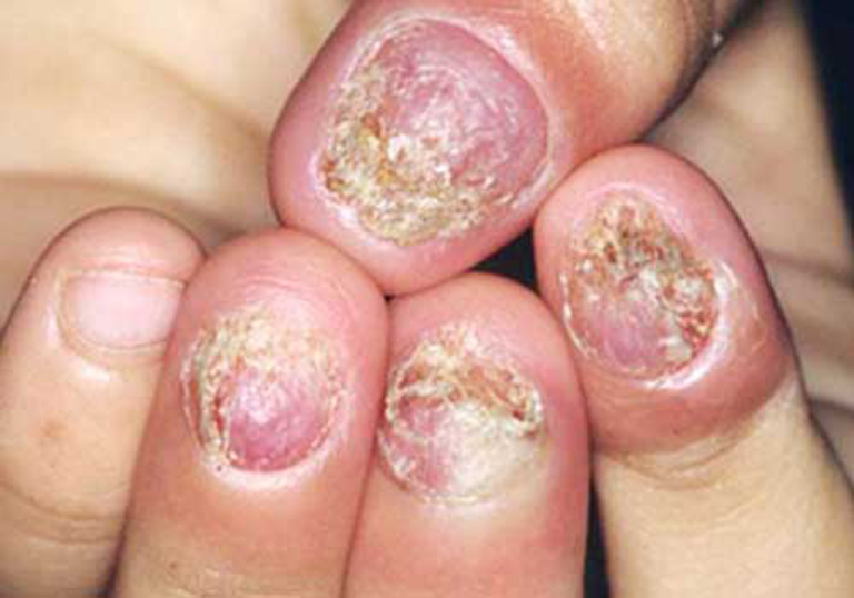 Bệnh nấm móng tay, chân và cách điều trị dứt điểm?
