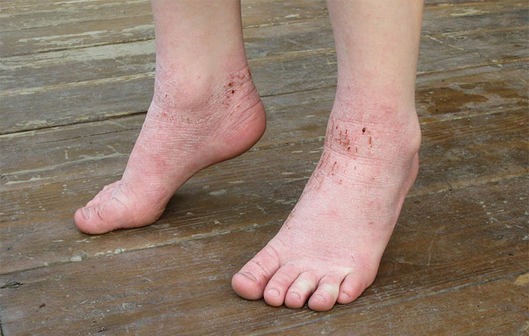 Bệnh tổ đỉa ở chân: Hình ảnh nhận biết và cách điều trị dứt điểm