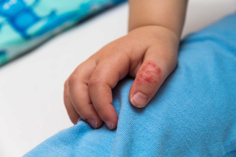 Bệnh tổ đỉa ở trẻ em: Nguyên nhân, dấu hiệu và cách điều trị