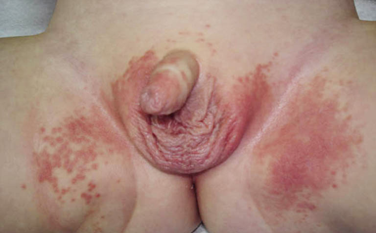 hình ảnh bệnh chàm sinh dục