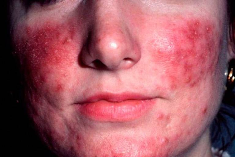 Rosacea là bệnh da liễu mạn tính phổ biến với các biểu hiện điển hình như da mặt đỏ ửng.