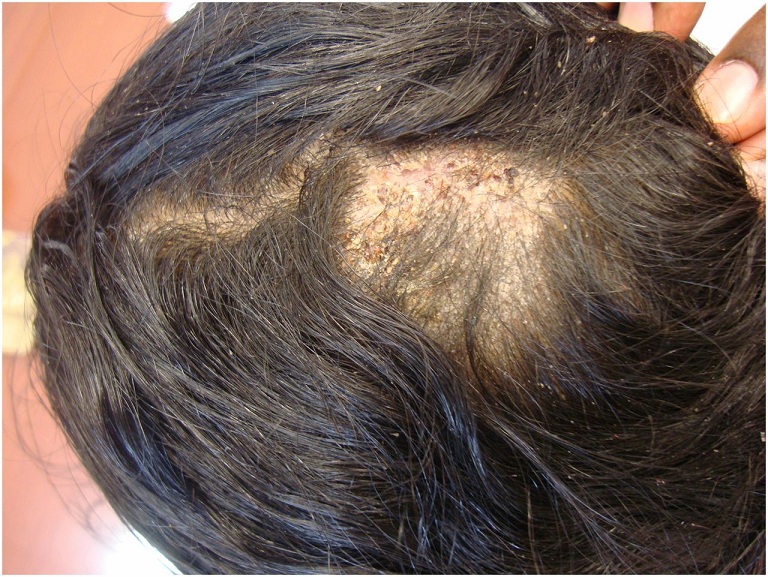 Dấu hiệu bệnh nấm da đầu