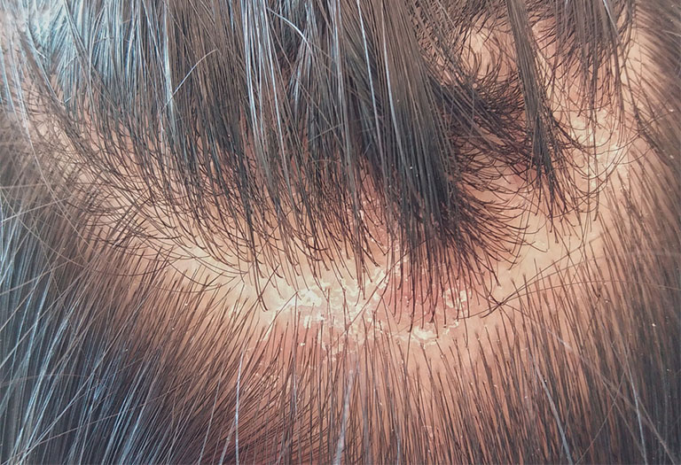 nấm da đầu và cách điều trị