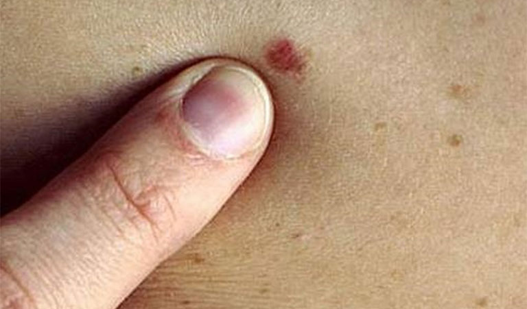 ung thư da gây nổi đốm đỏ không ngứa trên da