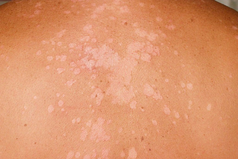 bệnh lang ben gây nổi đốm đỏ trên da không ngứa