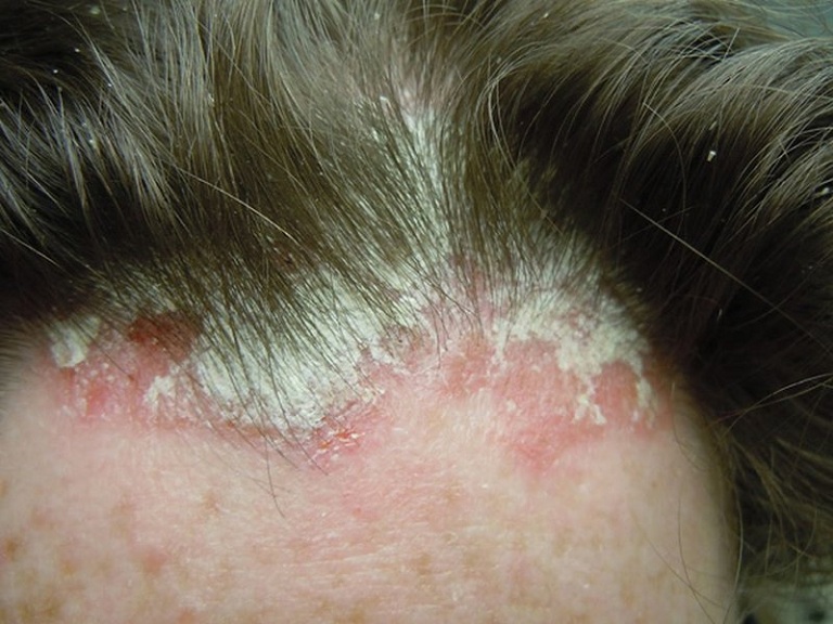 Bệnh á sừng ở da đầu – Nguyên nhân và cách điều trị đúng