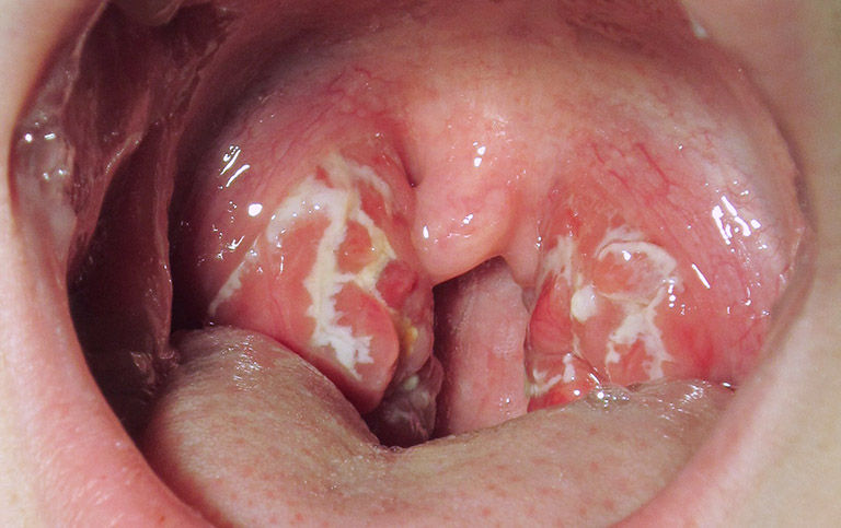 Viêm họng hạt có mủ là tình trạng viêm nhiễm nặng ở vùng họng