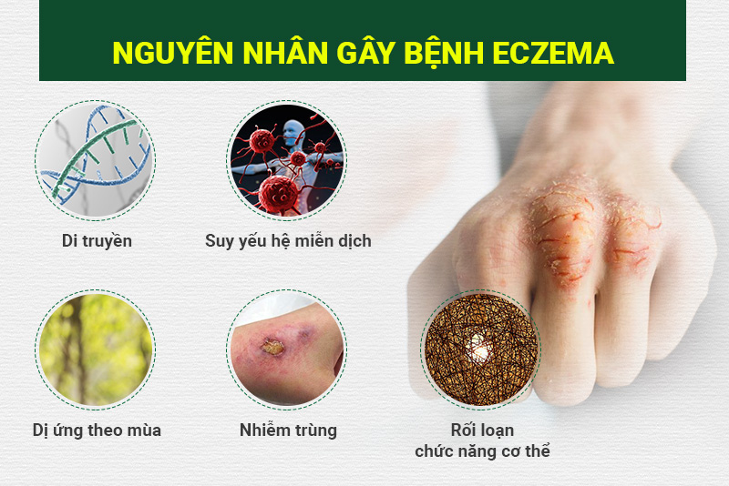 Nguyên nhân gây bệnh eczema 