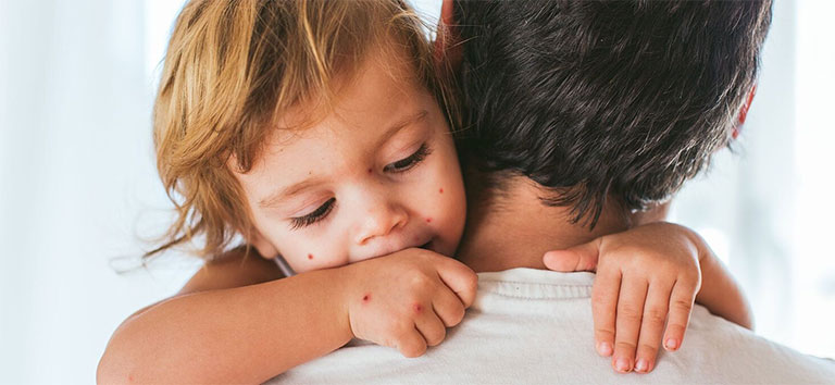 Bệnh thủy đậu ở trẻ em – Cách chăm sóc và điều trị mau khỏi