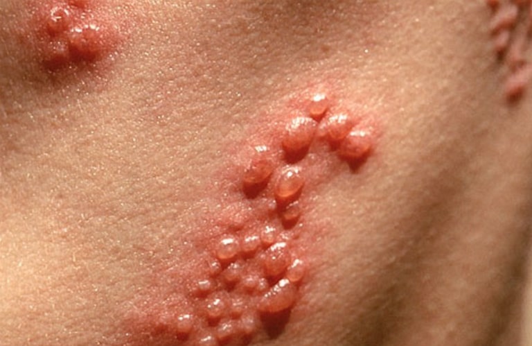 Giời leo là tình trạng da bị nổi mụn nước do tiếp xúc với nọc độc của côn trùng.