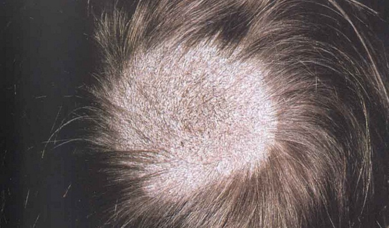 Bệnh nấm tóc