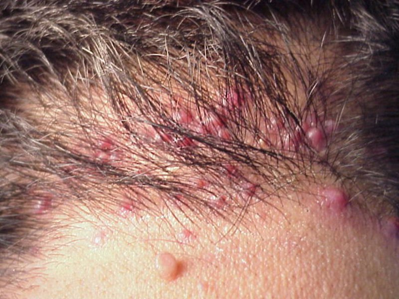 Bệnh viêm chân tóc là một trong các bệnh về da đầu phổ biến