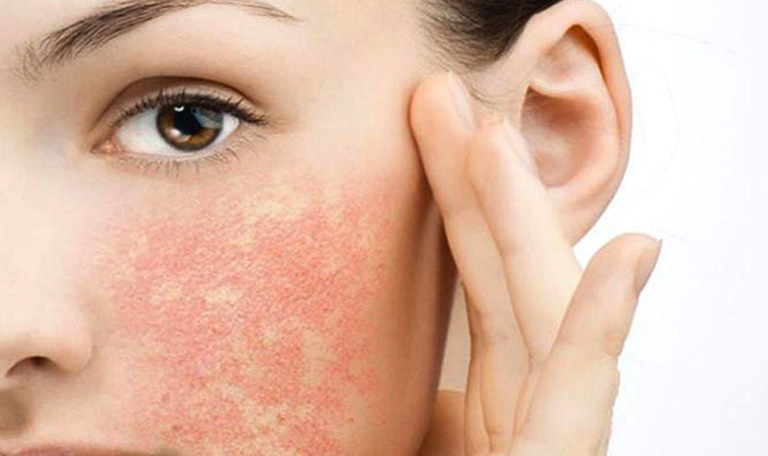 Tình trạng dị ứng mỹ phẩm có thể kích hoạt ở bất cứ vùng da nào, điển hình là da mặt