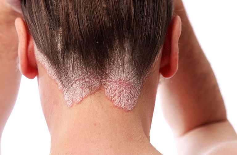 Bệnh vảy nến da đầu có thể lan rộng sang tai, sau trán và gáy