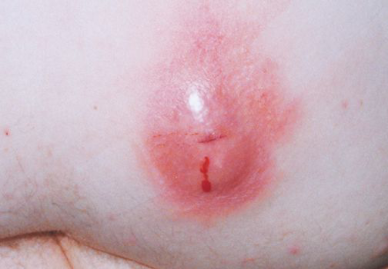 Mụn nhọt ở mông nếu tự ý nặn có thể gây ra tình trạng nhiễm trùng máu