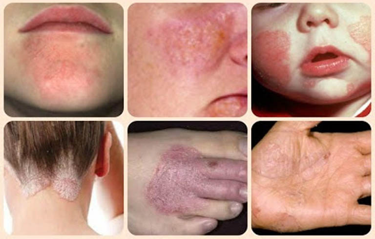 Biều hiện chàm eczema tái phát dai dẳng