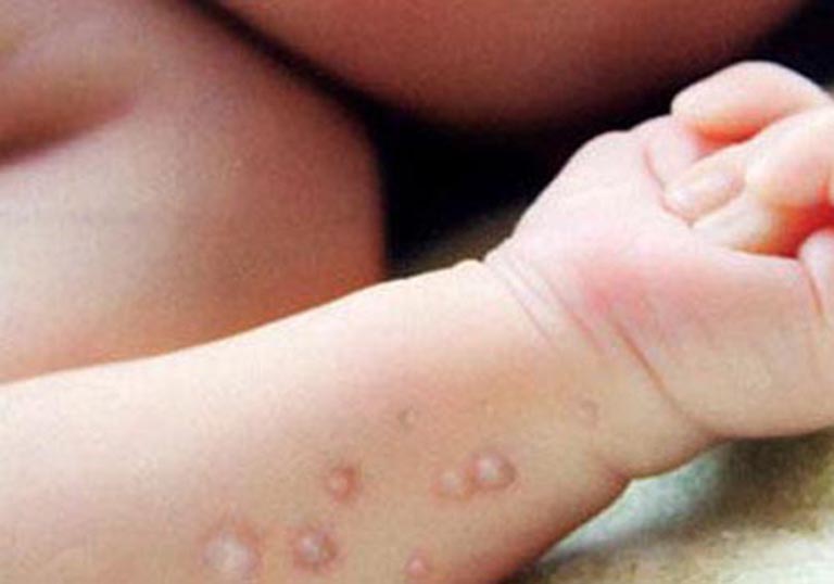 Bệnh tay chân miệng gây nổi mụn nước ở trẻ sơ sinh
