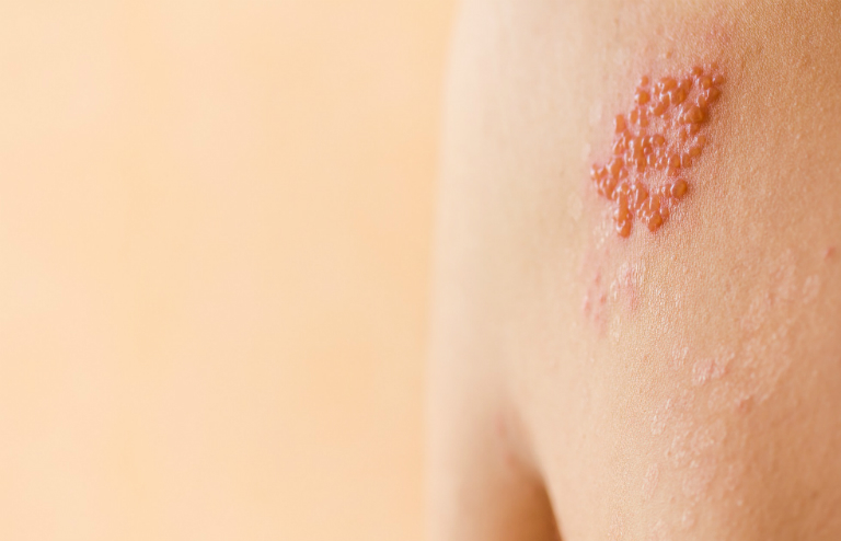 Giời leo là hiện tượng da xuất hiện những vết mẩn đỏ, mụn nước do tiếp xúc với chất độc của côn trùng.