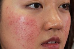 Tình trạng da mặt nổi mụn như rôm có thể do nhiều nguyên nhân gây ra