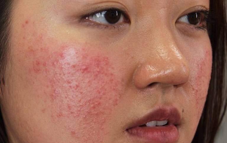 Tình trạng da mặt nổi mụn như rôm có thể do nhiều nguyên nhân gây ra