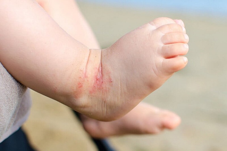 dị ứng là nguyên nhân khiến trẻ bị nổi mụn ngứa ở chân và tay do dị ứng