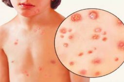 Tình trạng nổi bóng nước trên da có thể là dấu hiệu của bệnh thủy đậu