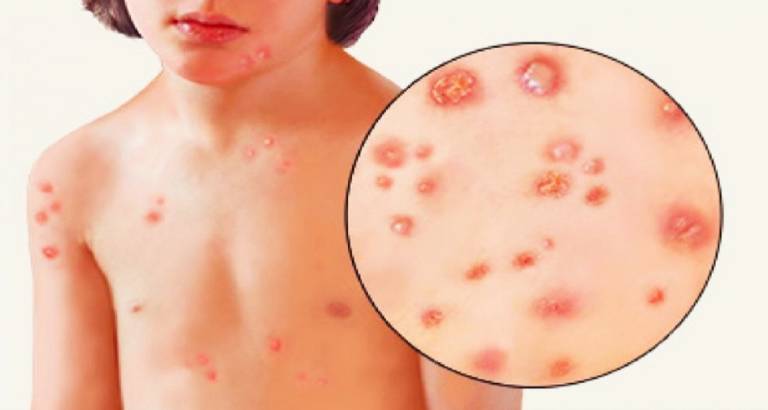 Tình trạng nổi bóng nước trên da có thể là dấu hiệu của bệnh thủy đậu