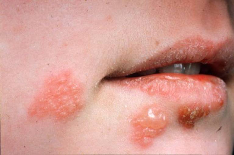Herpes rộp nước là bệnh với các mụn nước chứa đầy dịch kèm theo cảm giác ngứa rát
