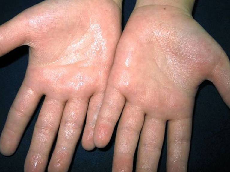 Ra mồ hôi tay chân có thể là dấu hiệu của nhiều bệnh