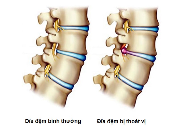 Thoát vị đĩa đệm cột sống thắt lưng: Triệu chứng và cách điều trị