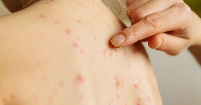 Bệnh thủy đậu có thể lây nhiễm qua đường tiếp xúc ngoài da thông thường.