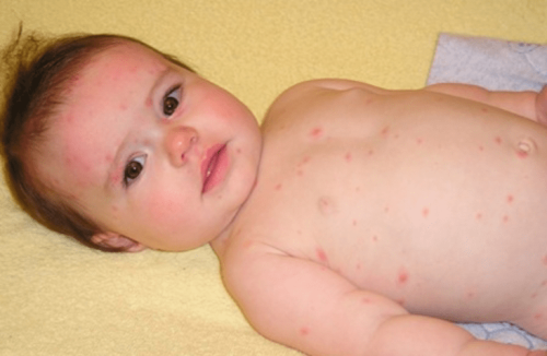 Nếu các mẩn đỏ không kèm theo sốt, bé bỏ bú li bì thì không nguy hiểm