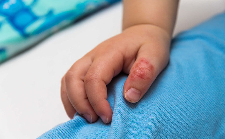 Trẻ em bị tróc da đầu ngón tay – Nguyên nhân và cách chữa an toàn