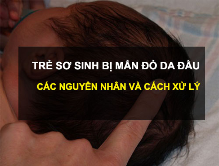 Trẻ sơ sinh bị nổi mẩn đỏ ở da đầu do nhiều nguyên nhân gây ra