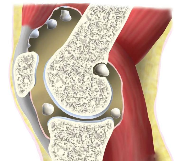 U sụn màng bao hoạt dịch là tình trạng các khối sụn nhỏ mọc chồi lên bề mặt từ ổ khớp