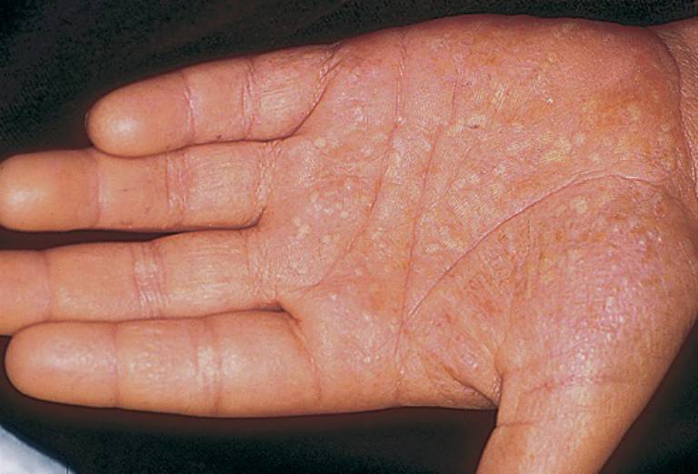 Các mụn mủ của bệnh vẩy nến thể mủ có thể xuất hiện ở lòng bàn tay