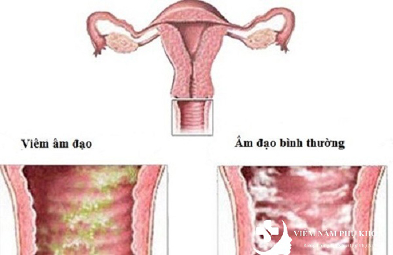 Viêm âm đạo là bệnh phụ khoa thường gặp ở phụ nữ sau sinh