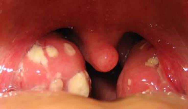 Viêm họng liên cầu khuẩn là bệnh nhiễm trùng cổ họng do virus Streptococcus gây ra
