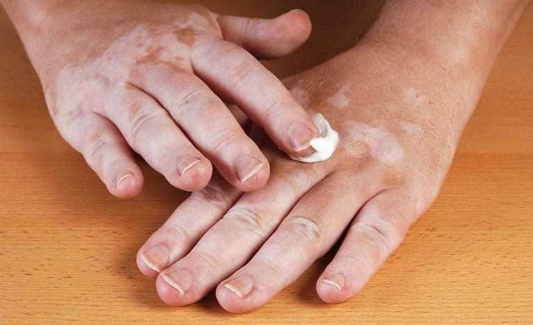 Người bệnh bạch biến có thể điều trị kết hợp thoa kem và chiếu các bước sóng ánh sáng vào da.
