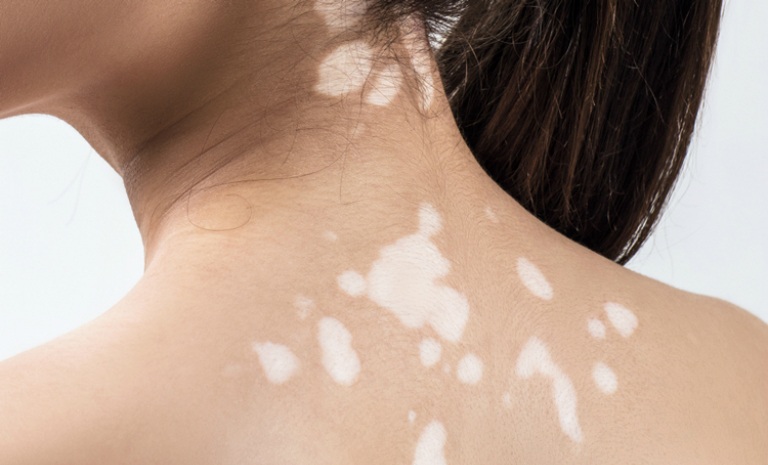Dùng phấn mỹ phẩm che khuyết điểm do bệnh bạch biến gây ra thường phù hợp với tình trạng mất màu ở vùng da nhỏ.