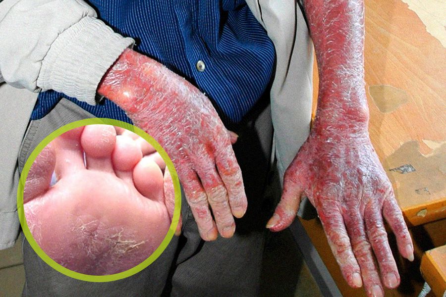Á sừng tay, chân, mặt: Triệu chứng và cách điều trị hiệu quả từ Đông y