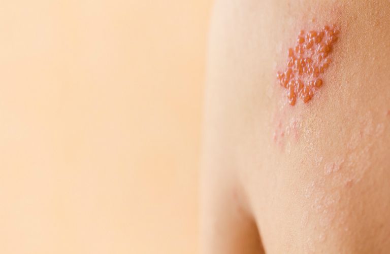 Giời leo là tình trạng viêm da tiếp xúc khi người bệnh tiếp xúc với nọc độc của côn trùng.
