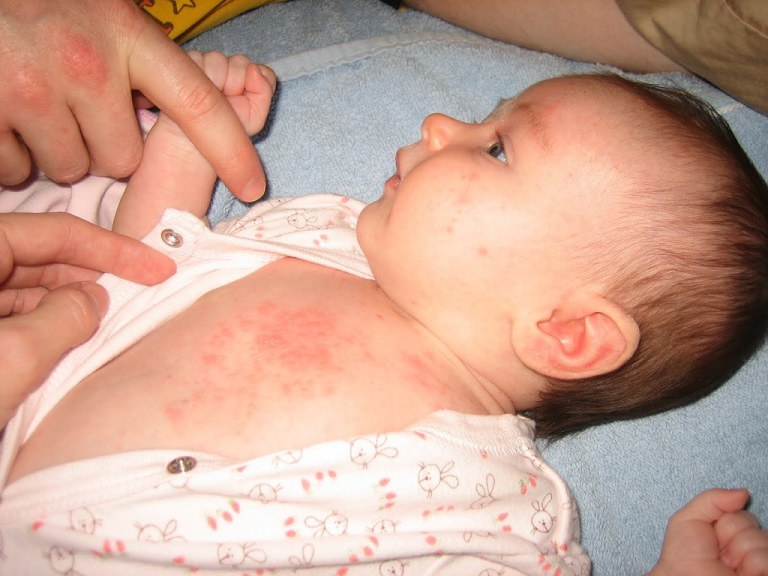 Bệnh nhiễm trùng da ở trẻ em