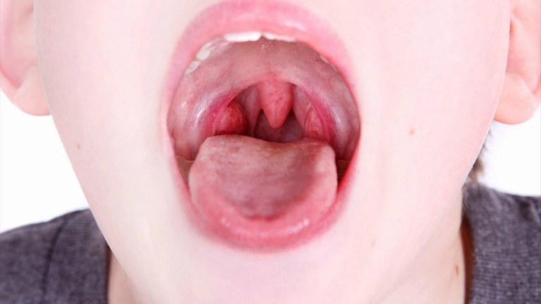 Viêm amidan là tình trạng các tế bào miễn dịch ở vòm họng bị sưng viêm. Cắt amidan sưng viêm là một trong các cách để điều trị.